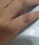 Трещины на сгибах пальцев рук фото 1