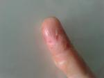 Появилась сыпь из мелких волдырей после пореза пальца фото 2