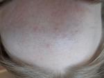 Чёрные точки расширенные поры высыпания бугристость кожи фото 3