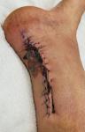 Осложнения на послеоперационном шве после операция по восстановлению ахилесового сухожилия фото 1