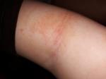Аллергия у ребенка по телу, немного чешется, шереховатая кожа фото 3