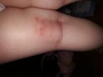 Аллергия у ребенка по телу, немного чешется, шереховатая кожа фото 2