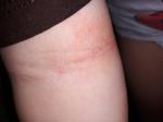 Аллергия у ребенка по телу, немного чешется, шереховатая кожа фото 1