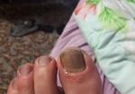 Болит палец на ноге фото 1