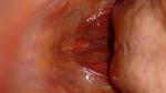 Боль в горле, воспаленные лимфоузлы фото 1