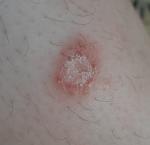 Красное круглое пятно на ноге, опасно ли это заболевание? фото 1