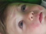 Покраснение на щеках и лбу у ребенка фото 2