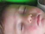 Покраснение на щеках и лбу у ребенка фото 1