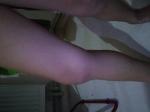 Боль и припухлость колена внутренней стороны фото 1