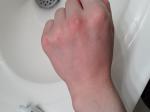Восстановление кожи рук. Последствия дерматита фото 1