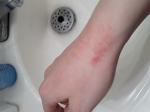 Восстановление кожи рук. Последствия дерматита фото 2