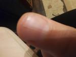 Трещина ногтя меланома? фото 1