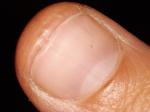 Трещина ногтя меланома? фото 2