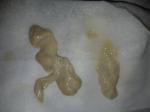 Бело желтые сгустки, зуд, при беременности фото 1