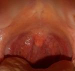 Блокада миндалин и боли в горле фото 3