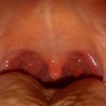 Блокада миндалин и боли в горле фото 2