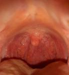 Блокада миндалин и боли в горле фото 1