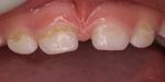Разрушение зубов фото 1