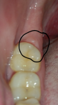 Нарост на десне около зуба фото 1