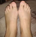 Боли в ступнях и пальцах ног фото 2