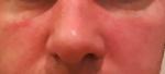 Зудящее покраснение вокруг носа с шелушением гловы фото 1