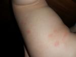 Аллергия или болезнь фото 4