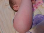 Сыпь на теле ребенка 8 месяцев фото 5