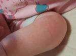 Сыпь на теле ребенка 8 месяцев фото 3