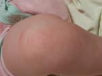 Сыпь на теле ребенка 8 месяцев фото 2