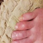 Зуд и покраснение пальца ноги нерегулярно фото 1