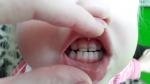 Темные полосы на передних зубах у ребенка фото 1
