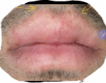 Покраснение в области верхней губы фото 1