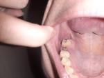 Норма лунки на 6 день после удаления зуба фото 1