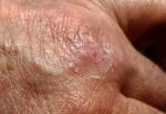 Периодическое проявление болезни кожи фото 1