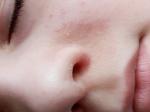 Сыпь вокруг носа у ребенка фото 1