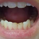 Трещины на зубах фото 1