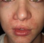 Краснота и мелкая сыпь на лице подростка фото 3