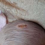 Повреждение у новорожденного фото 1