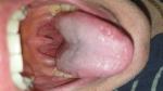 Болит горло и приступы удушья без кашля и постоянной температуры фото 1