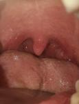 Боль в горле, увеличен лимфоузел, нарост на миндалине фото 1