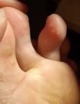 Маленькие твердые образования на пальцах ног фото 1