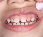 Точка на зубе у ребенка фото 1