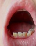 Желтые пятна на зубах фото 1