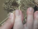 Красная сыпь на пальцах ног и рук фото 3