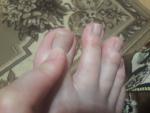 Красная сыпь на пальцах ног и рук фото 2