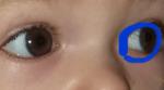 Черная точка в глазу у ребенка фото 1