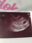 КТР эмбриона, пропали признаки беременности фото 1