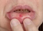 Как лечить припушлость на нижней губе? фото 2
