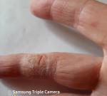 Трещины и сухость пальцев рук фото 1
