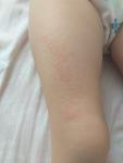 Сыпь на ногах у ребенка фото 3